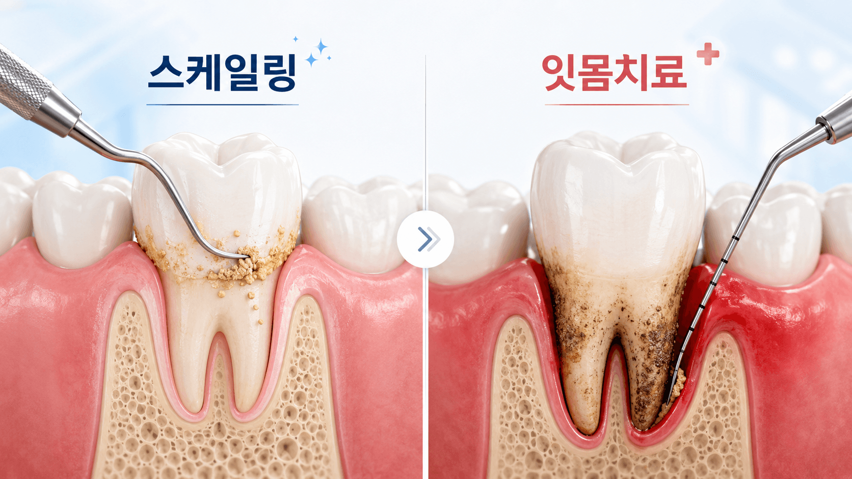 스케일링과 잇몸치료의 차이